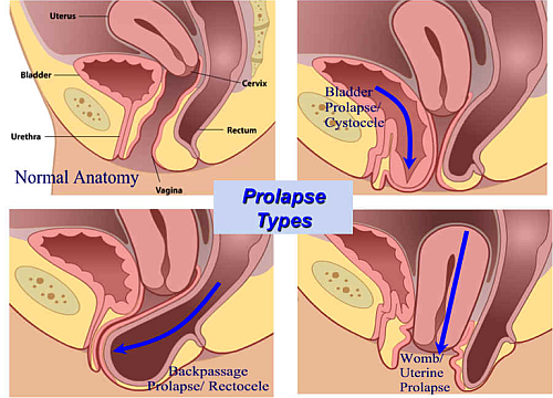 Abdominal Organ Prolapse