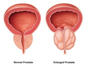 Prostate enlargement due to Benign Prostatic Hyperplasia
