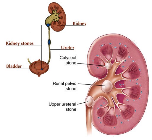 anatomy of kidney stones