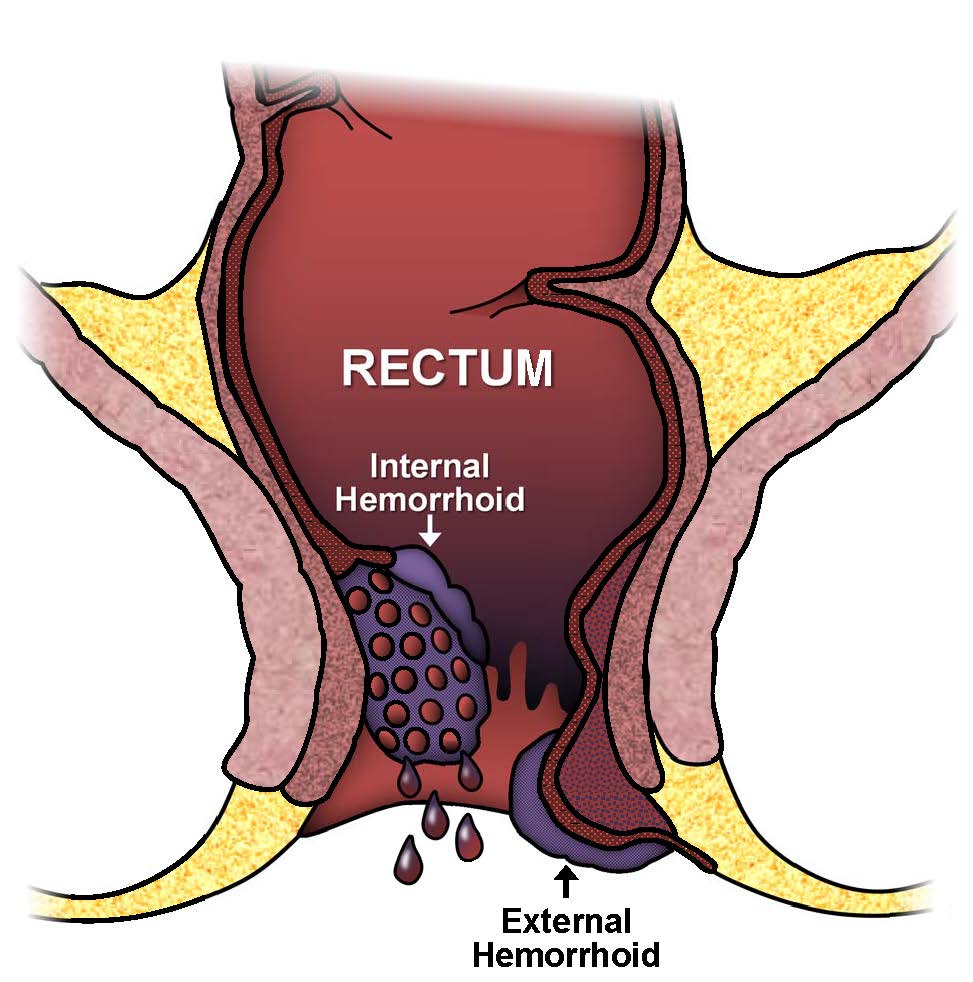 Internal and external hemorrhoids