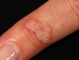 HPV on finger