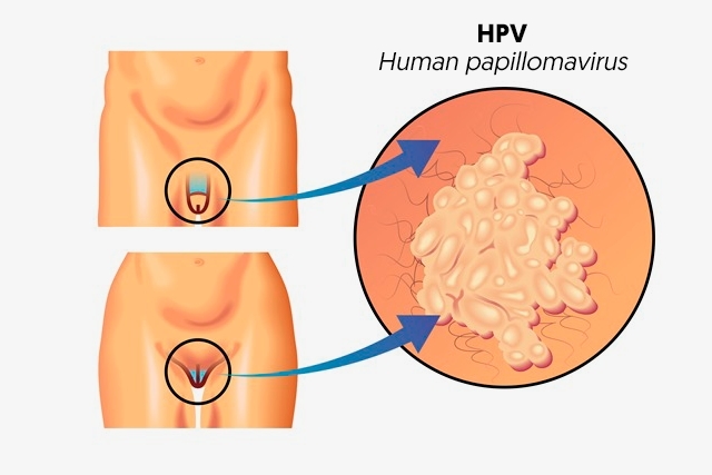 HPV and Genital Warts